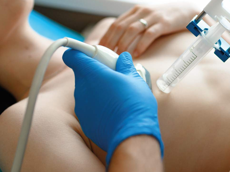Biópsia de Mama (Core - Biopsy)