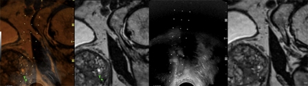 RADIOLOGIA INTERVENCIONISTA : TECNOLOGIA DE PONTA NO DIAGNÓSTICO DE CÂNCER DE PRÓSTATA. 