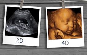 ULTRASSOM 4D NO I.R.M.A.
